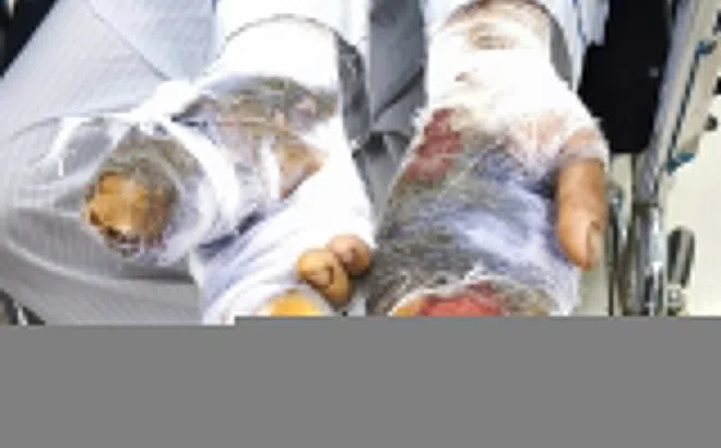 Chó nhà lao vào cắn nát hai bàn tay của chủ khi đang cho ăn