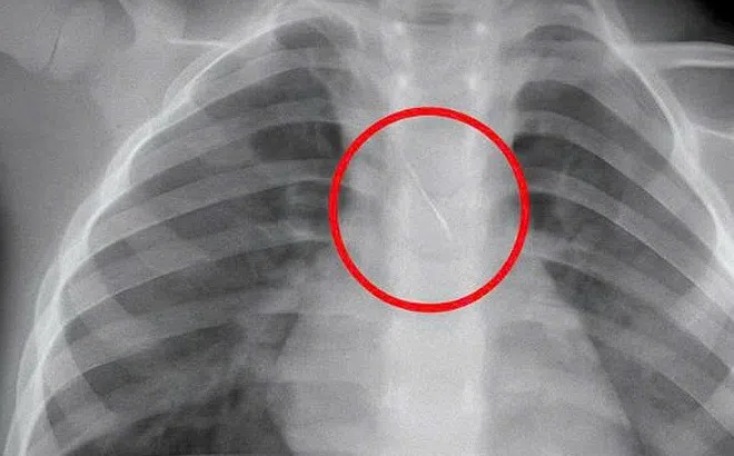 Kim chọc tủy dài 22mm rơi vào đường thở bé trai 3 tuổi khi làm răng