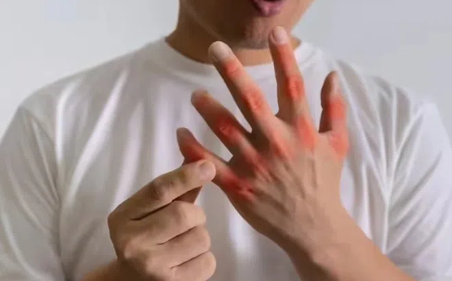 Dấu hiệu cảnh báo nồng độ axit uric tăng cao