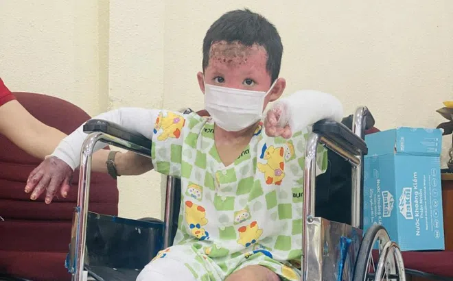 Tình hình bé trai bị bỏng 65% cơ thể trong vụ phóng hỏa ở Gia Lai