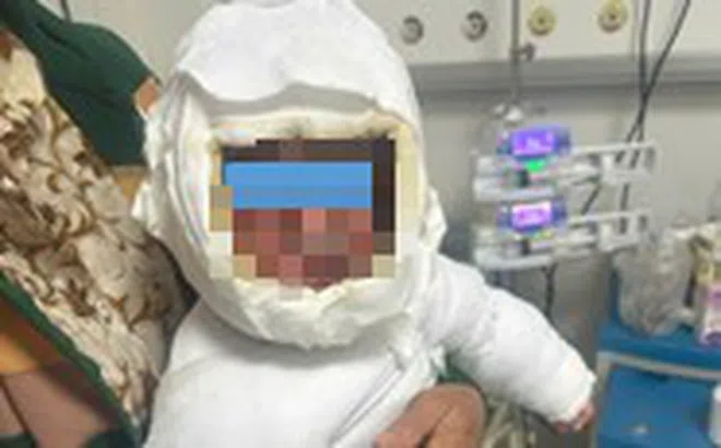 Bé 9 tháng tuổi bỏng 30% cơ thể vì kéo dây điện ấm siêu tốc